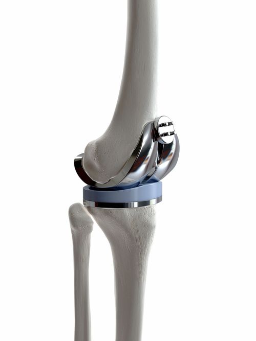 Above Knee Prosthetic Leg PrimeCare Orthotics & Prosthetics